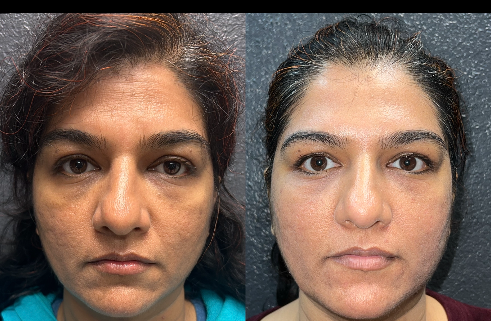 Actual Grace patient before and after Lutronic Spectra facial pigment treatment