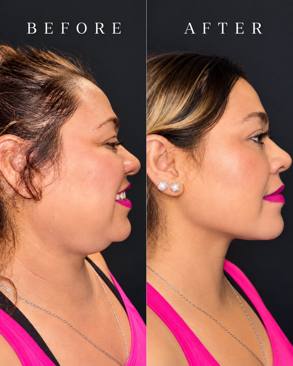 Grace MedSpa double-chin contouring before and after in Austin, shown in right profile