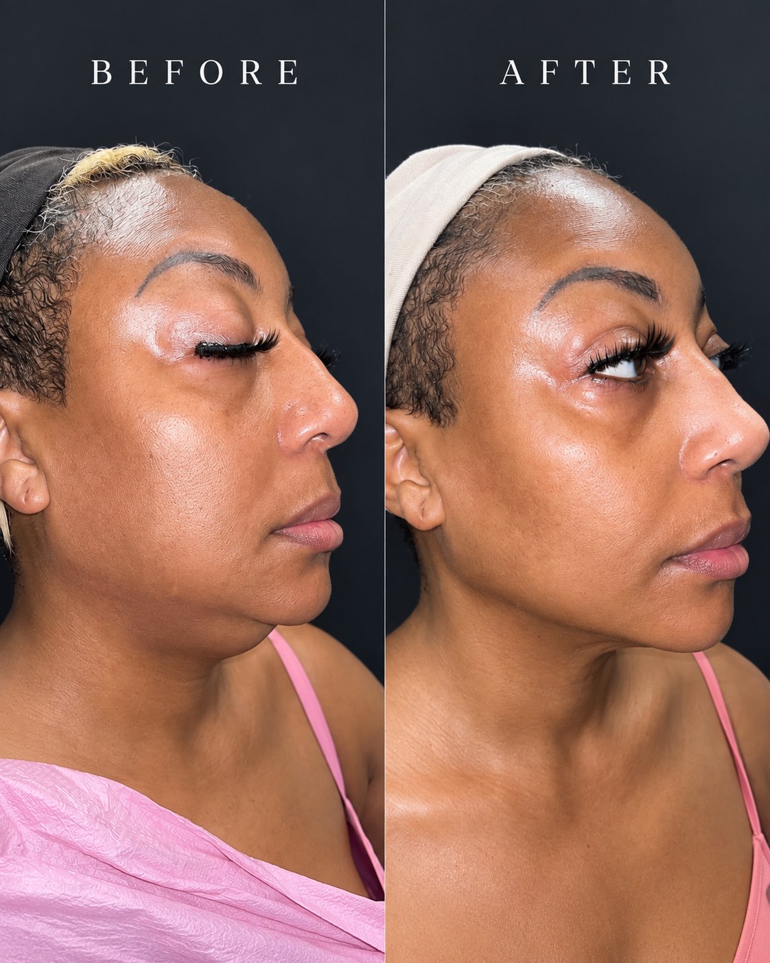Grace MedSpa double-chin contouring before and after in Austin for an actual patient