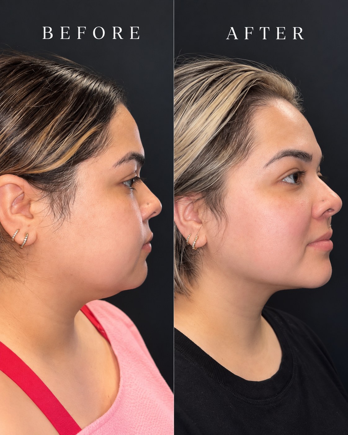 Grace MedSpa under-chin contouring before and after in Austin, shown in right profile