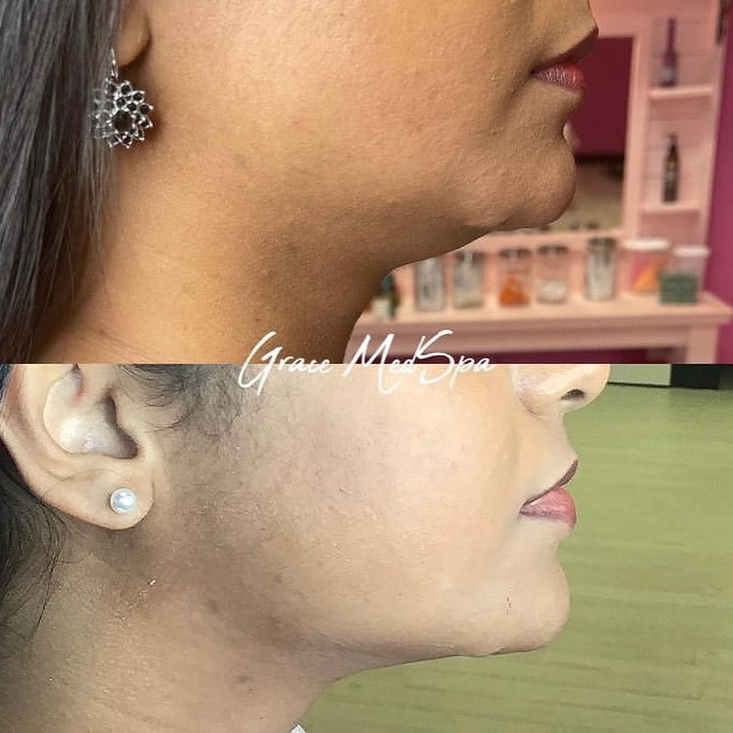 Actual Grace patient under-chin archive fat-dissolving treatment before-and-after comparison 4