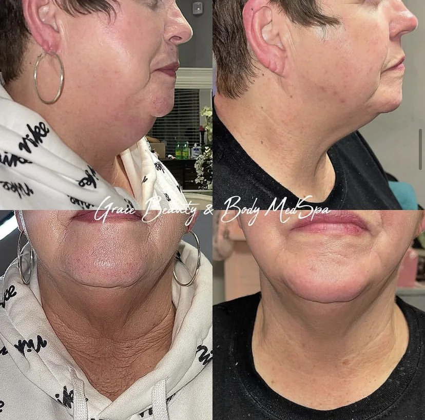 Chin and neck before and after LipoDissolve treatment