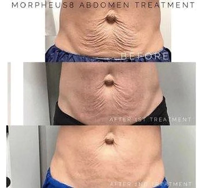 Abdomen before Morpheus8 Body treatment, after the first session and after the second session