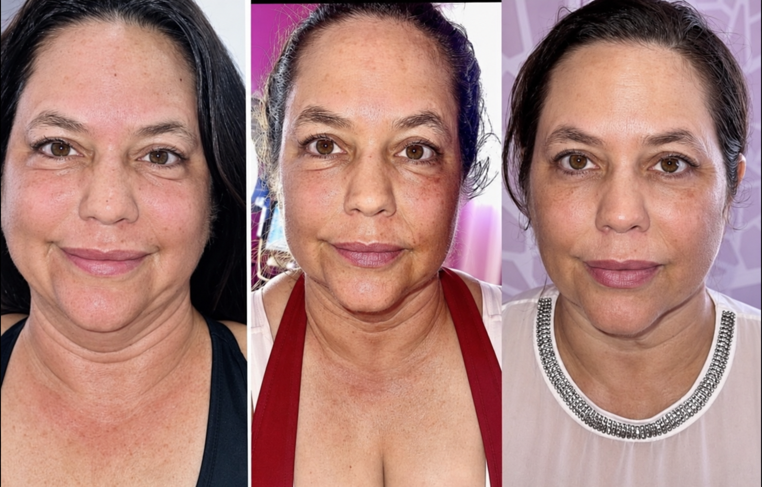 Before Morpheus8 Face treatment, after the first session and after the second session