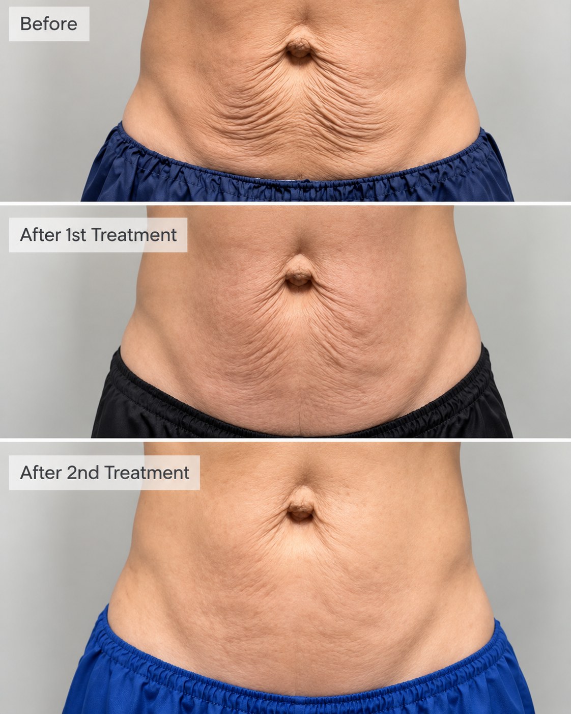 Abdomen before Morpheus8 Body treatment, after the first session and after the second session
